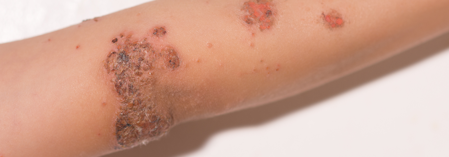 Impetigo treatment Faringdon