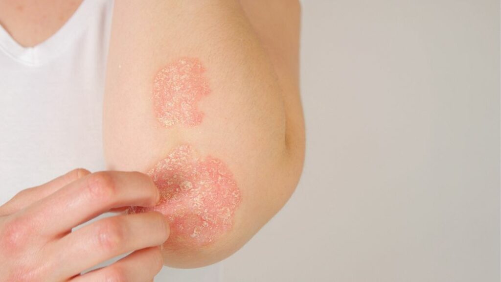 Eczema and Dermatitis