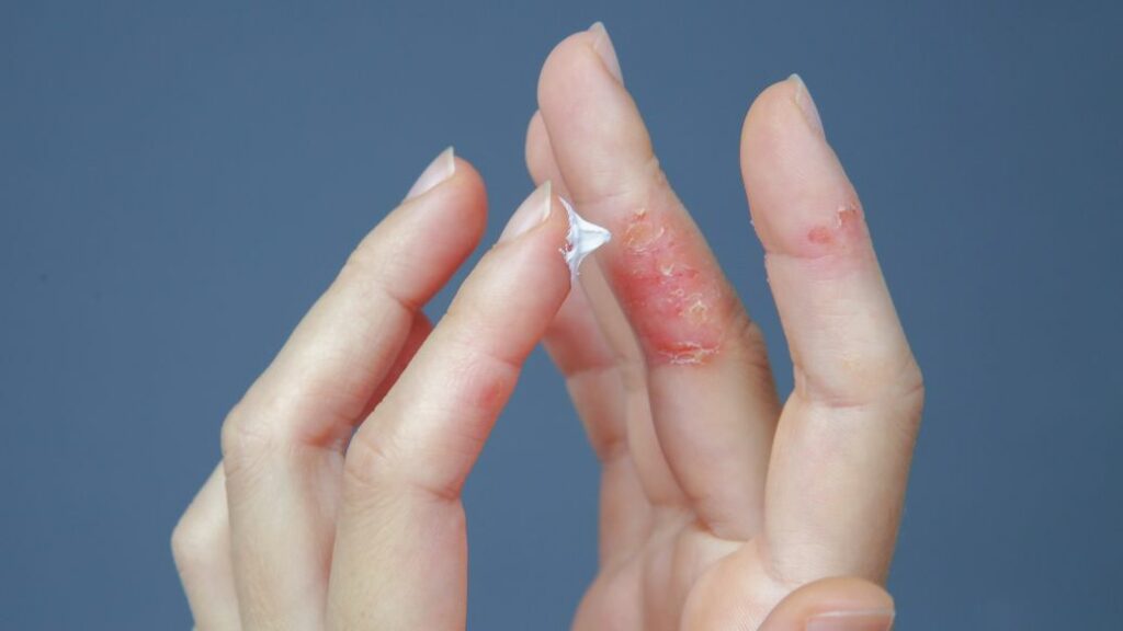 Eczema and Dermatitis treatment