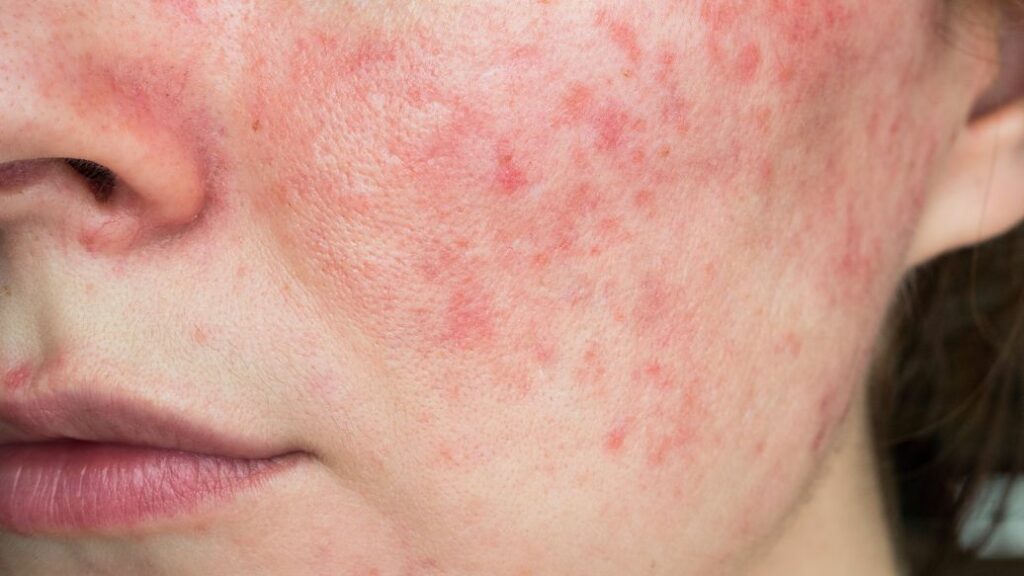 rosacea treatment